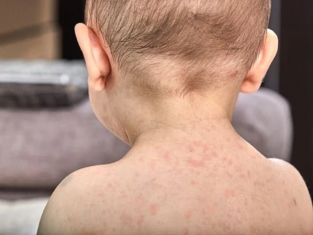 Bebeklerde Pişik Kremi Bebeklerde Pişik Kremi