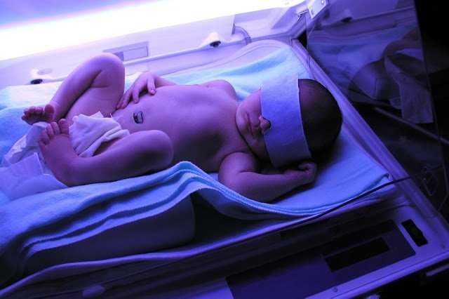 Yeni Doğan Sariliği Belirtileri Yeni Doğan Sariliği Belirtileri