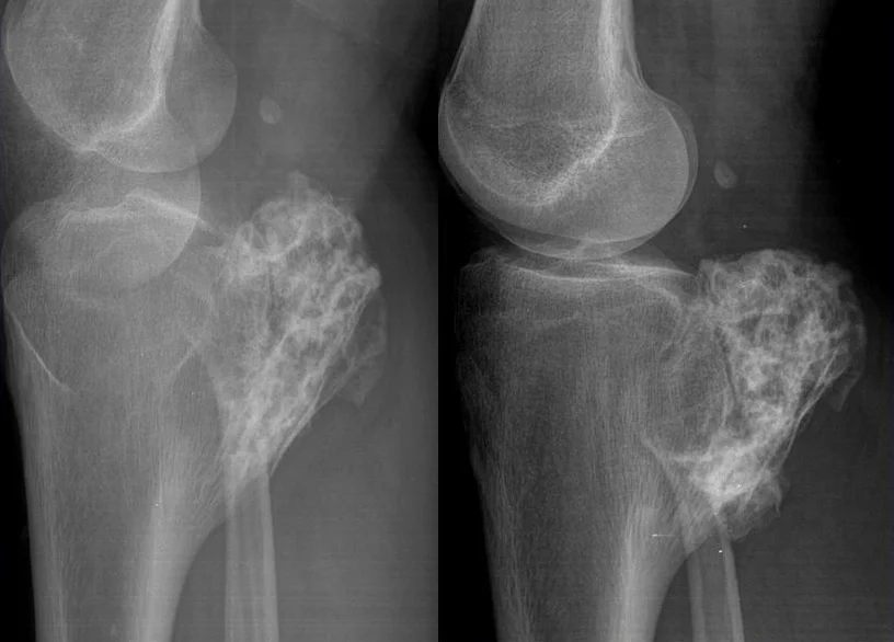 Osteokondrom Nedir